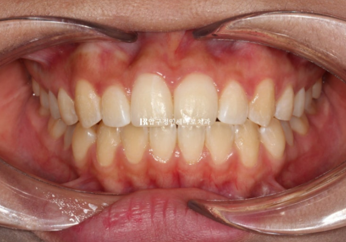 압구정 교정치과 덧니 부분교정 단기교정 후기 관련 이미지 6