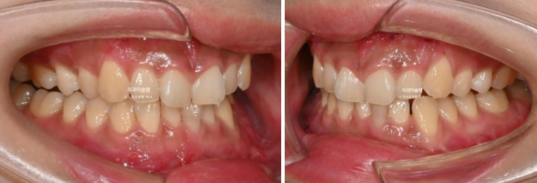 선수술 양악수술 비대칭 주걱턱 잇몸미소 치료 인비절라인 라이트 관련 이미지 4