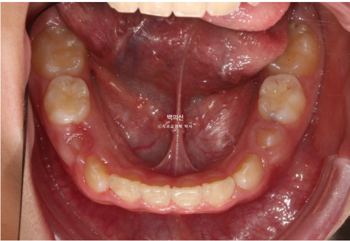 소아 비대칭 교정 인비절라인 퍼스트 재제작 1회 MA 치료 관련 이미지 10
