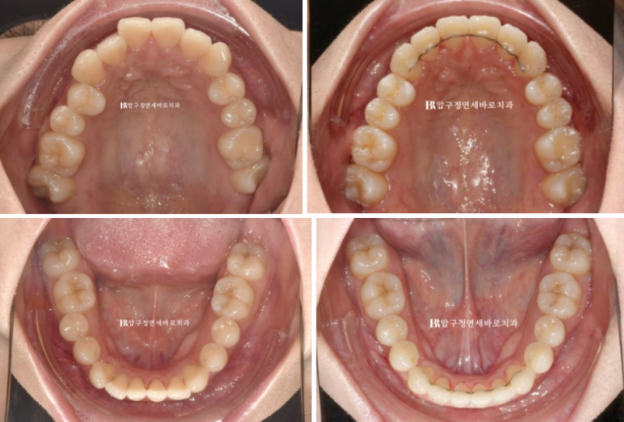 9-Month Invisalign Lite Review|Real Case Improving a Crossbite and Crooked Teeth Together image 10