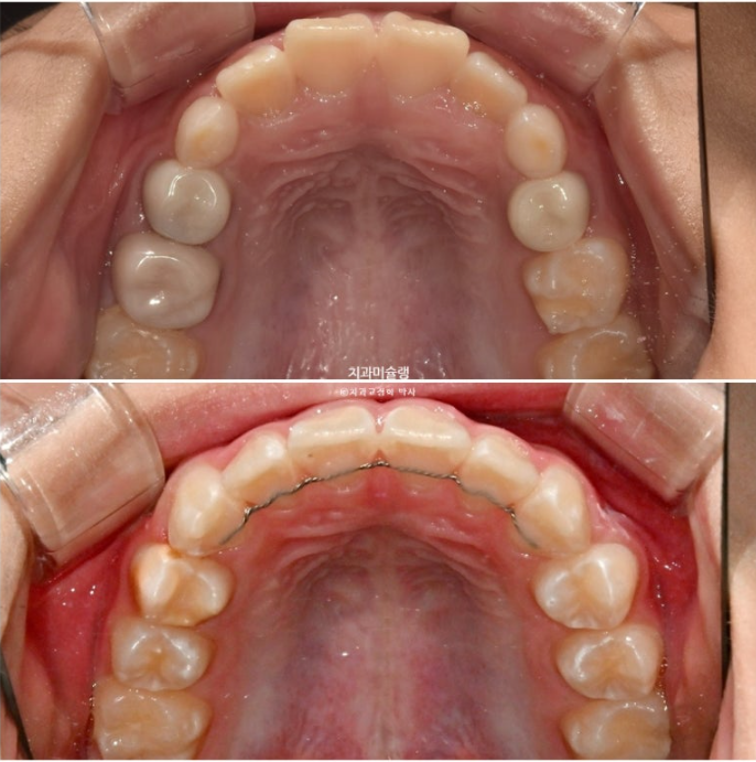 어린이 돌출입 교정 무턱 투명교정 인비절라인 퍼스트 관련 이미지 22