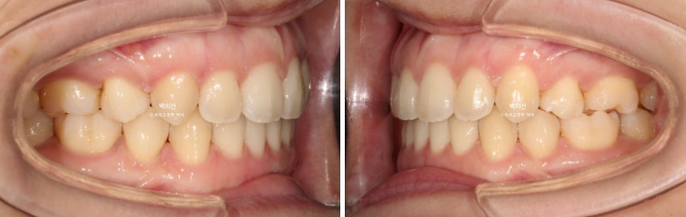 돌출입 교정 인비절라인 발치 교정 개방교합 치료 후기 관련 이미지 19