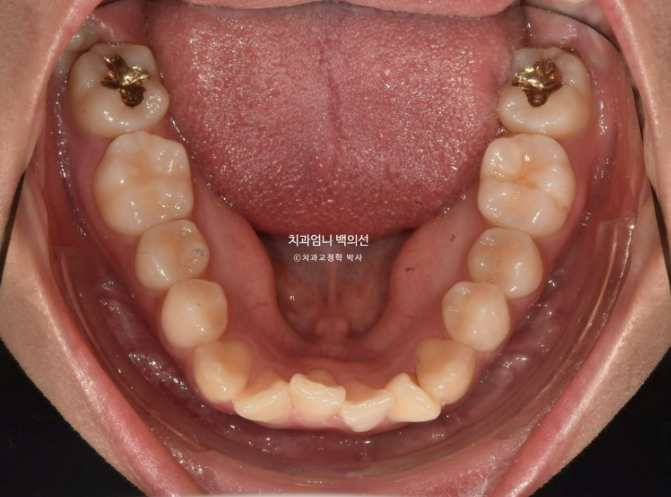 앞니 부분 교정 토끼이빨 덧니교정 ? 관련 이미지 6