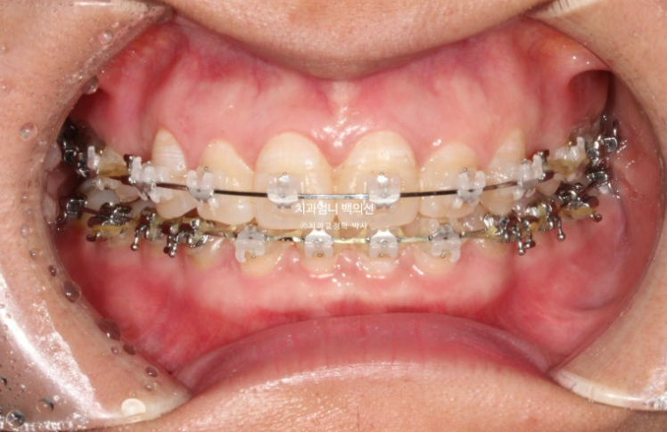 30대 교정 돌출입 교정 덧니 발치교정 치료기간 1년 8개월 관련 이미지 6