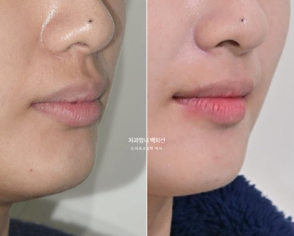 돌출입 교정 인비절라인 발치 교정 후기 관련 이미지 20
