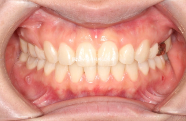 Gummy Smile Correction Review | Natural Improvement of Gummy Smile and Buccal Corridors Through Extraction Treatment for Protruding Teeth image 8