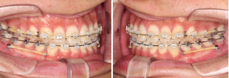 비수술 비발치 주걱턱 절충치료 클리피씨 개방교합 반대교합 치료 관련 이미지 9