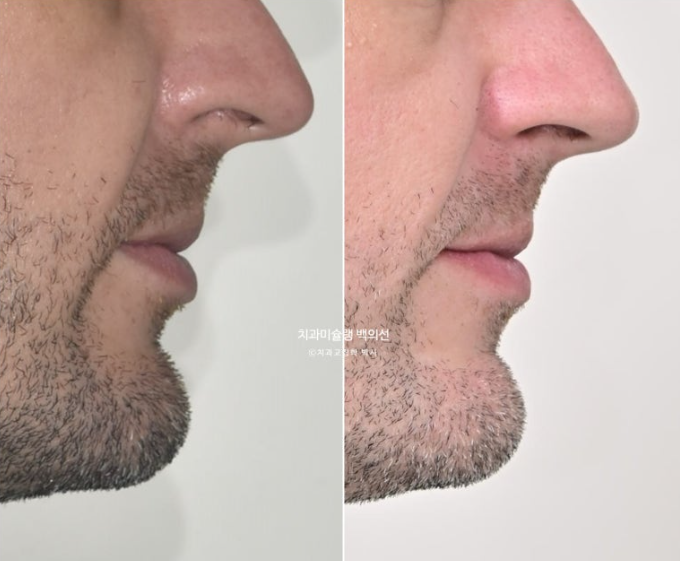 앞니 선천적 결손 인비절라인 임플란트 과개교합 치료 기간 관련 이미지 31