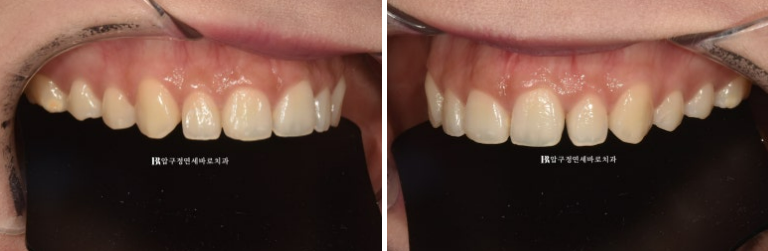 스마일라인 개선 무삭제 라미네이트 실제 두께 ? 관련 이미지 2