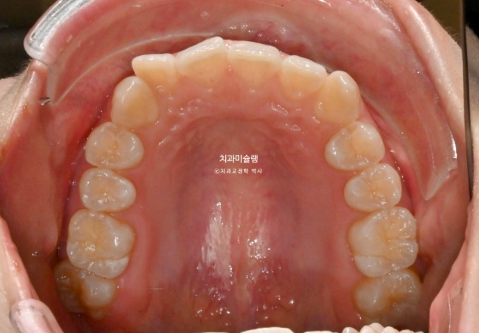 덧니 인비절라인 라이트 잇몸미소 거미스마일 중심선 블랙트라이앵글 관련 이미지 4