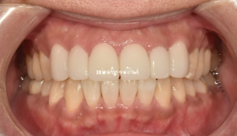 40대 중년 치아교정 인비절라인 라이트 치료기간 8개월 관련 이미지 11