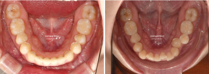 비발치 덧니 교정 인비절라인 과개교합 교정 무삭제 라미네이트 치료 후기 관련 이미지 19