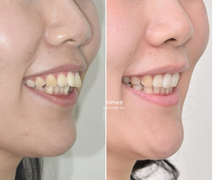 돌출입 덧니 발치 교정 인비절라인 교정 후기 관련 이미지 27