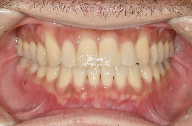 30대 MSE 악궁확장 덧니 반대교합 비발치 클리피씨 부작용 관련 이미지 13