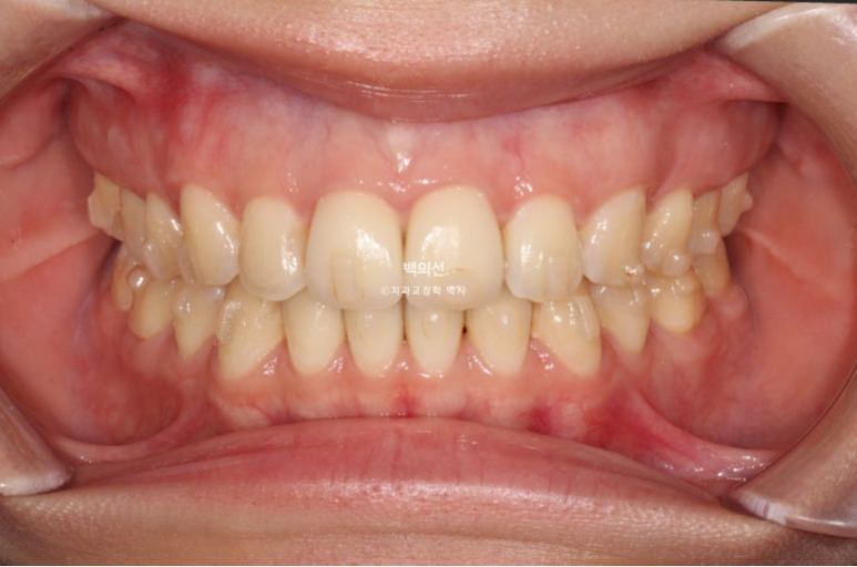 클리피씨 교정에서 인비절라인 변경 마무리 인비절라인 라이트 치료기간 4개월 관련 이미지 7