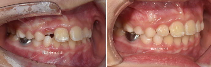 A Real Case of Preventing Crowded Teeth with Invisalign First for a Child in Gangnam image 4