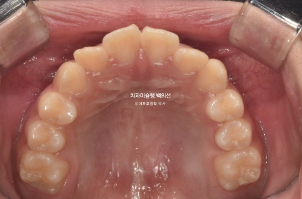 돌출입 무턱 인비절라인 발치교정 덧니 치료기간 1년 11개월 관련 이미지 4