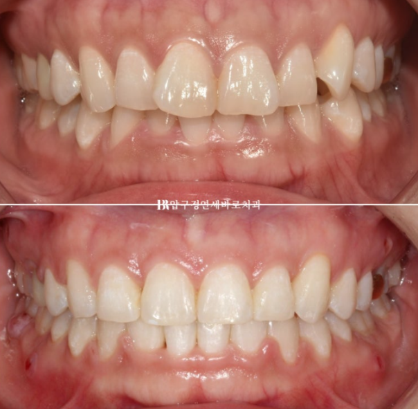 웃을 때 잇몸이 보여요. 잇몸미소 거미스마일 교정하기 관련 이미지 1