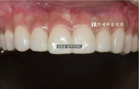 압구정 무삭제 라미네이트 가능할까? 관련 이미지 3