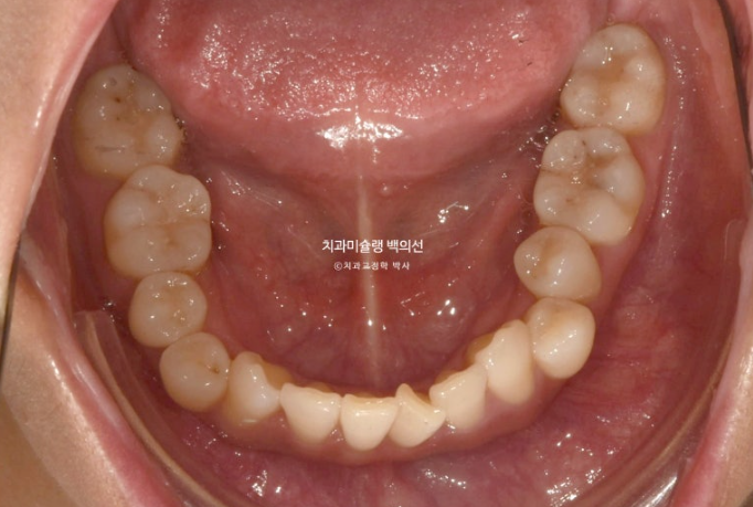 옥니 덧니 과개교합 반대교합 중심선 인비절라인 치료기간 1년 관련 이미지 5
