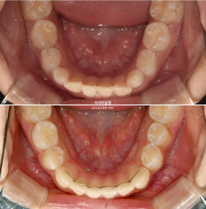 어린이 돌출입 교정 무턱 투명교정 인비절라인 퍼스트 관련 이미지 23