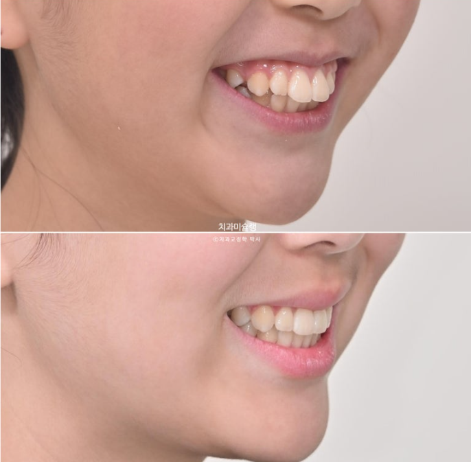 돌출입 비발치 어린이 교정 입술부전증 호두주름 호두턱 토끼이빨 인비절라인퍼스트 관련 이미지 1