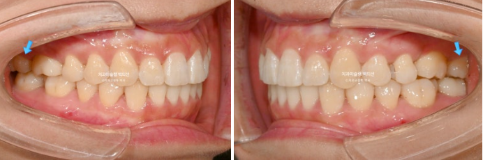 인비절라인 돌출입 발치교정 임플란트 없이 사랑니 대체 관련 이미지 19