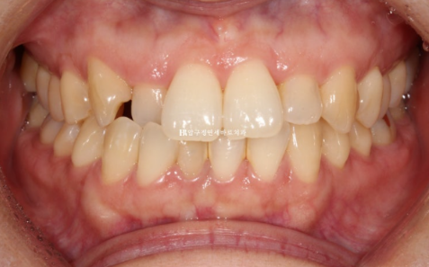 토끼이빨 치아교정 ? 토끼이빨 교정 치료기간은 어떻게 되나요? 관련 이미지 2