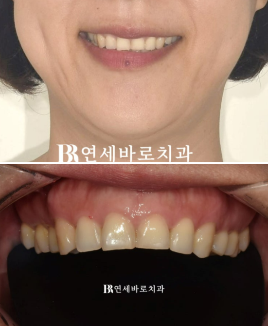역류성 식도염으로 갈린 치아&hellip; 무삭제 라미네이트로 자연스럽게 회복 관련 이미지 1