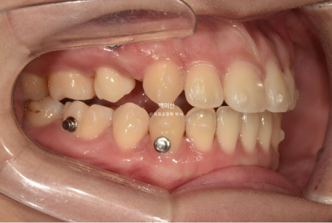 돌출입 교정 인비절라인 발치 교정 개방교합 치료 후기 관련 이미지 13