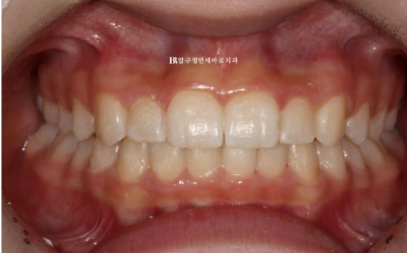 서울 인비절라인 덧니 교정 과개교합 후기 관련 이미지 7