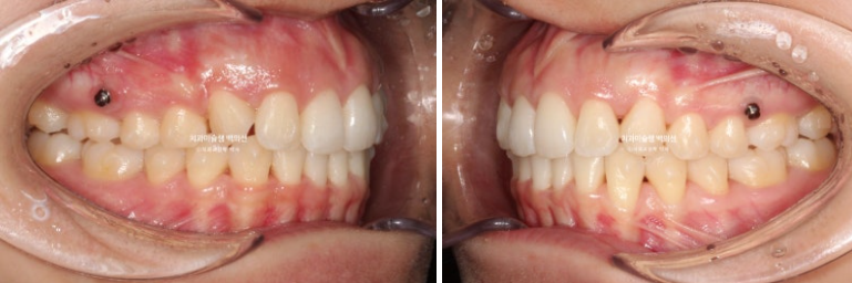 비발치 인비절라인 교정 돌출입 교정 후기 관련 이미지 8