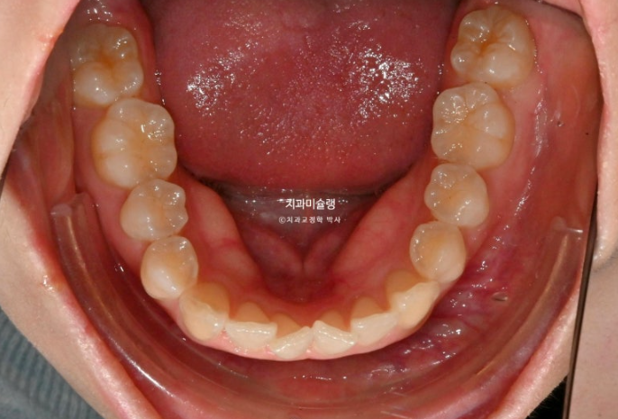 덧니 인비절라인 라이트 잇몸미소 거미스마일 중심선 블랙트라이앵글 관련 이미지 5