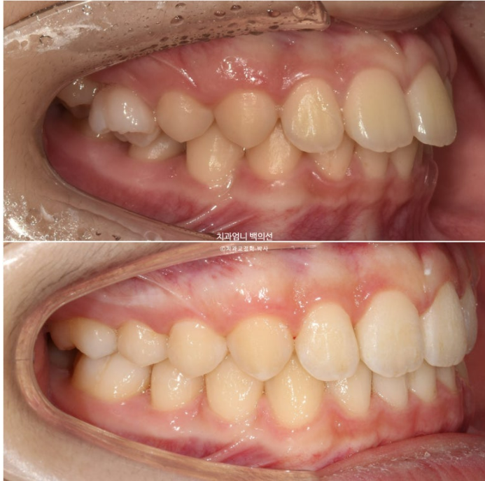 어린이 투명교정 인비절라인 퍼스트 가위교합 돌출교정 덧니교정 관련 이미지 13