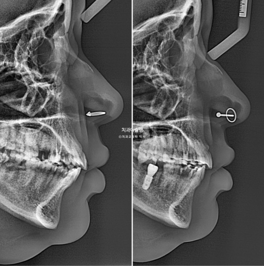 Extraction & re-orthodontics with Clippy-C, intrusion for dental implant. 관련 이미지 25