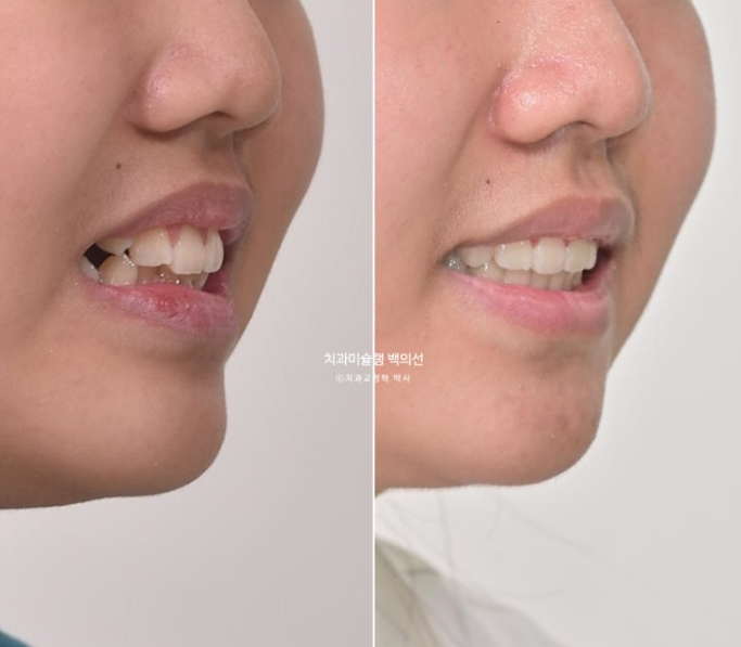 덧니 반대교합 과개교합 인비절라인 퍼스트 악궁확장 어린이 교정 치료 관련 이미지 27