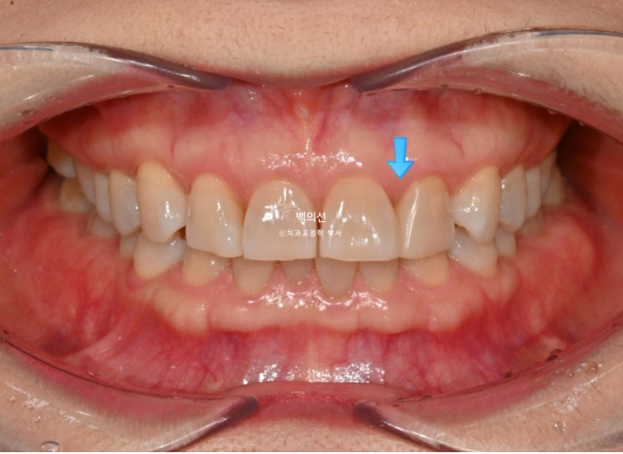 50대 치아교정 :: 인비절라인 익스프레스 치아 벌어짐 단기교정 후기 관련 이미지 2