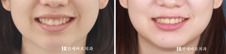 잇몸미소 거미스마일 원인에 따라 다른 치료방법? 관련 이미지 4