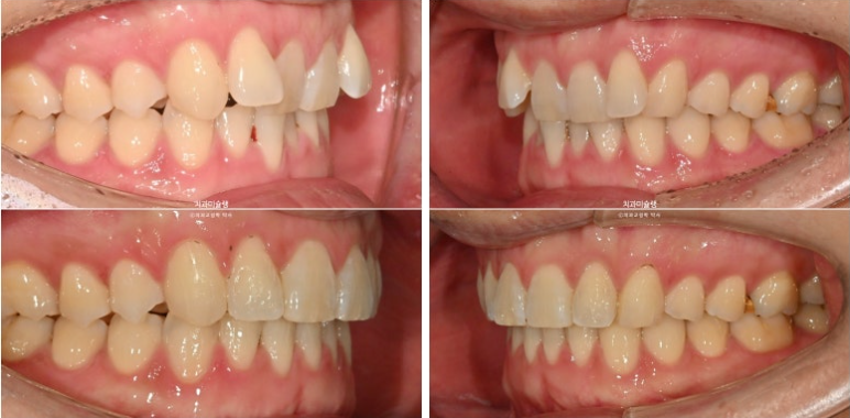 덧니 앞니 부분교정 급속교정 단기 MTA 미니튜브 기간 6개월 관련 이미지 12