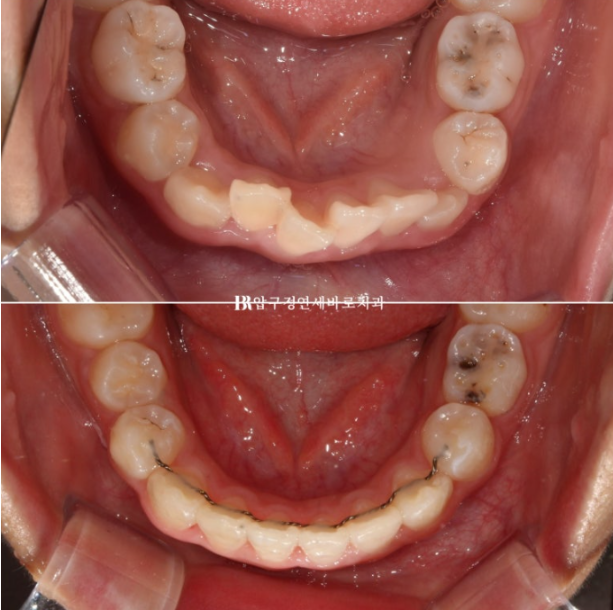 압구정 어린이교정 인비절라인 퍼스트 악궁확장 덧니 교정 관련 이미지 13