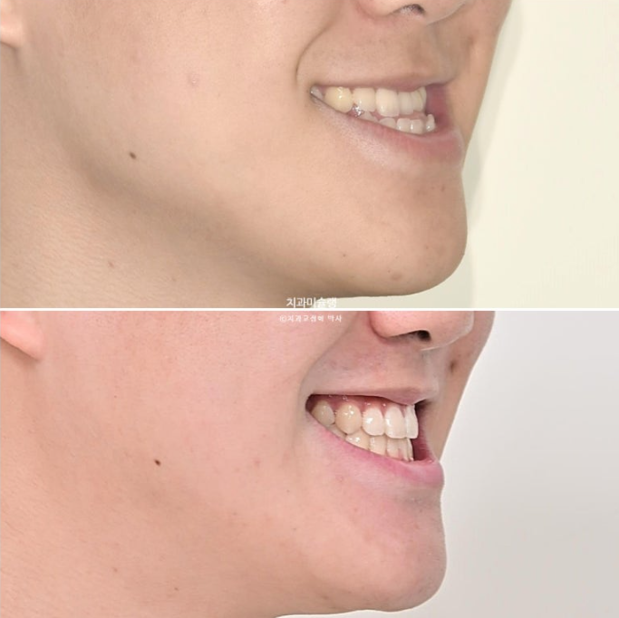 비수술 비발치 주걱턱 절충치료 클리피씨 개방교합 반대교합 치료 관련 이미지 17