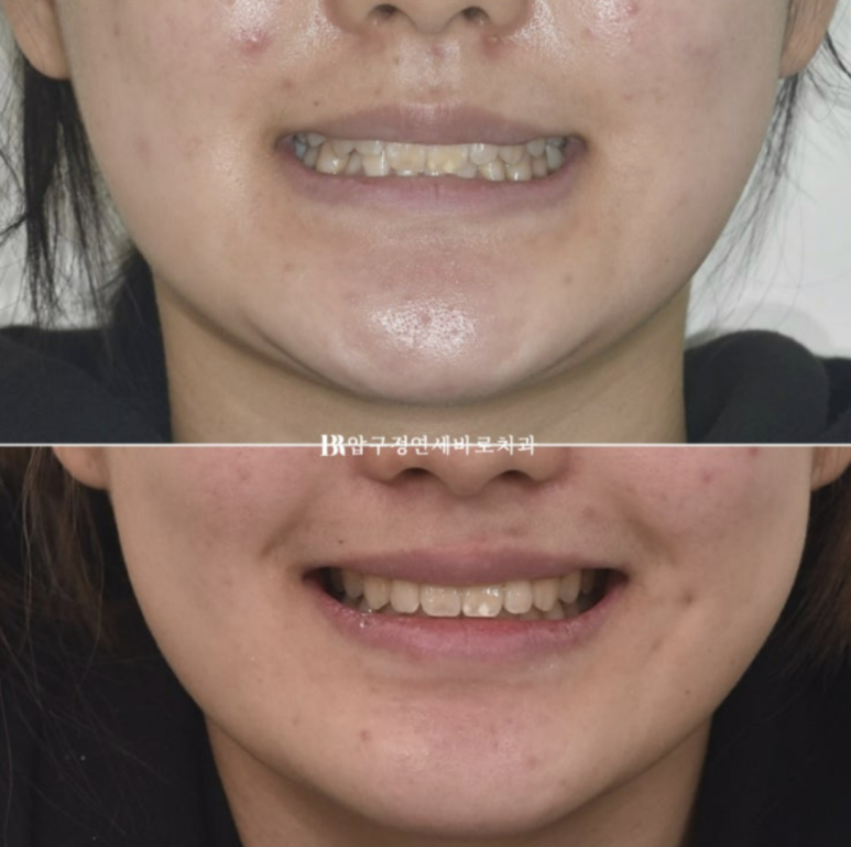 옥니교정 / 웃을때 아랫니만 보여요. 앞니 노출도 교정? 관련 이미지 14