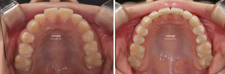 돌출입 비발치 어린이 교정 입술부전증 호두주름 호두턱 토끼이빨 인비절라인퍼스트 관련 이미지 16