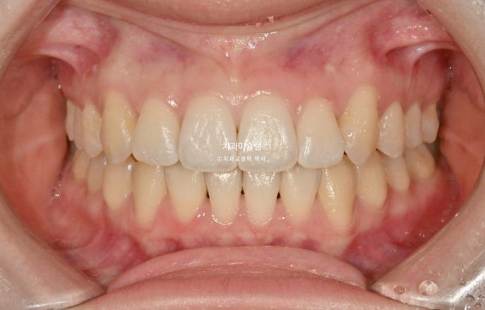 덧니 인비절라인 라이트 잇몸미소 거미스마일 중심선 블랙트라이앵글 관련 이미지 12