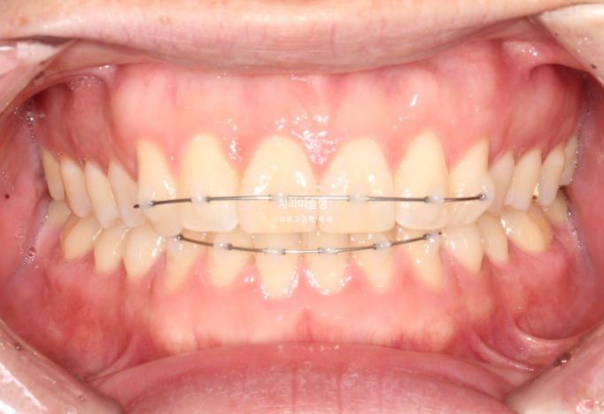 덧니 앞니 부분교정 급속교정 단기 MTA 미니튜브 기간 6개월 관련 이미지 6