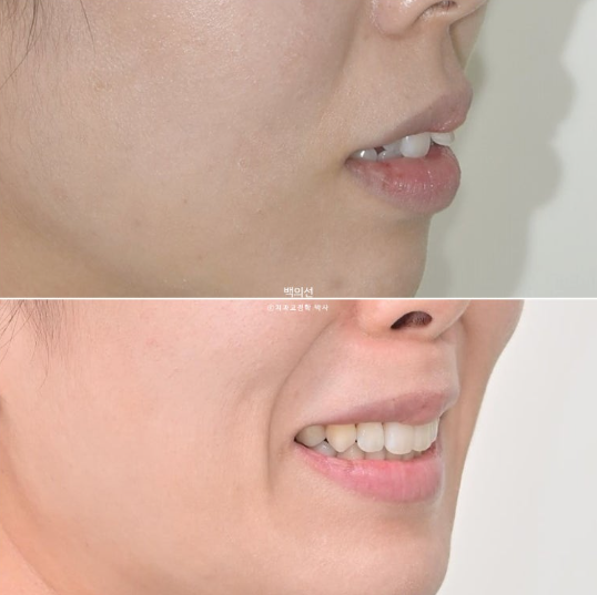 30대 돌출입 덧니 교정 인비절라인 발치교정 후기 관련 이미지 20