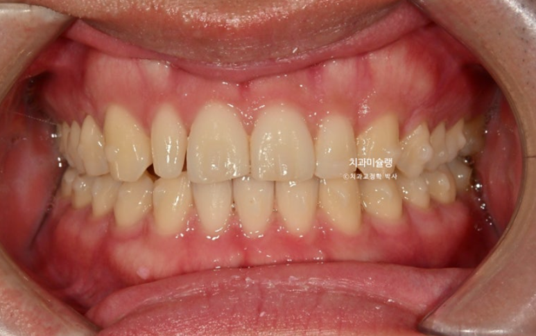옥니 덧니 교정 왜소치 선천적 결손 3전치 무삭제 라미네이트 인비절라인 교정 관련 이미지 12