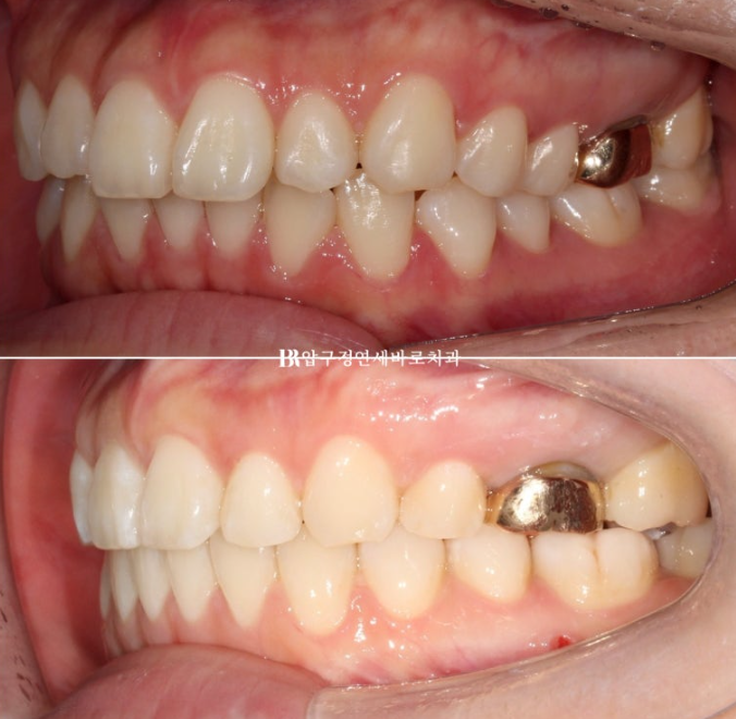 Gummy Smile Correction, Gummy Smile Orthodontics, Rabbit Teeth Correction image 13