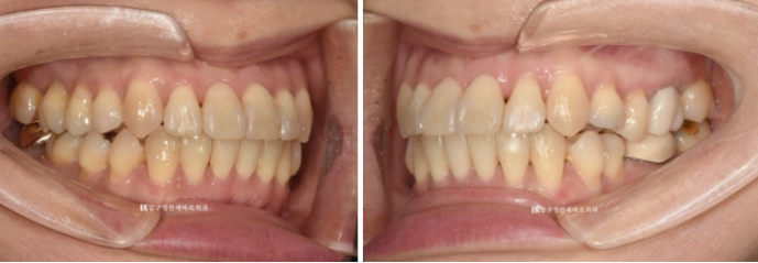 Orthodontics in Your 40s: Worried Your Gums Will Recede? | A 6-Month Front Teeth Partial Orthodontic Case That Also Improved Black Triangles image 8