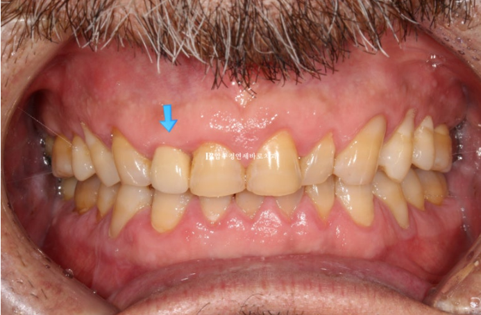 50대 중년교정 무삭제 라미네이트 중년 부분교정 후기 관련 이미지 2